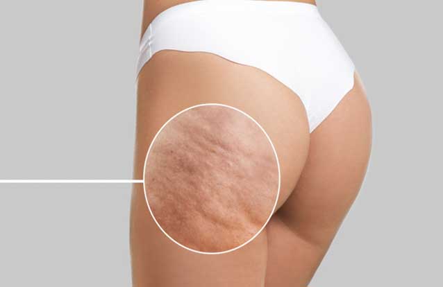 Woman in need of cellulite treatment in Bay Area