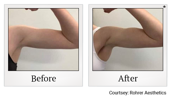 Results 3 of bodytone treatment at Bay Area Med Spas in Oakland and Fremont