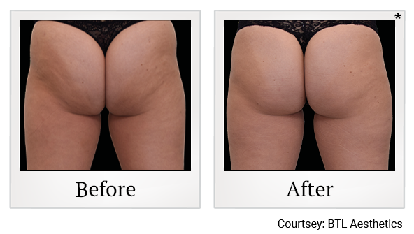 Results 9 of emsculpt neo treatment at Bay Area Med Spas in Oakland and Fremont