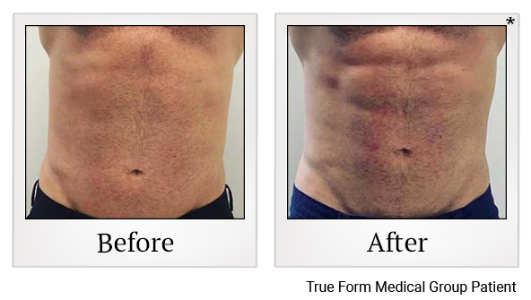 Results 90 of emsculpt treatment at Bay Area Med Spas in Oakland and Fremont