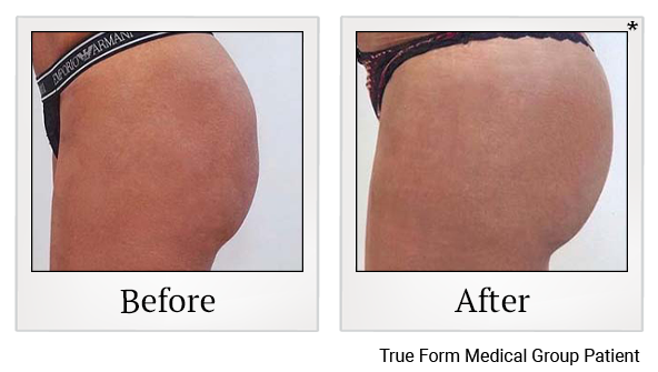 Results of Emsculpt treatment at Bay Area Med Spas in Oakland and Fremont