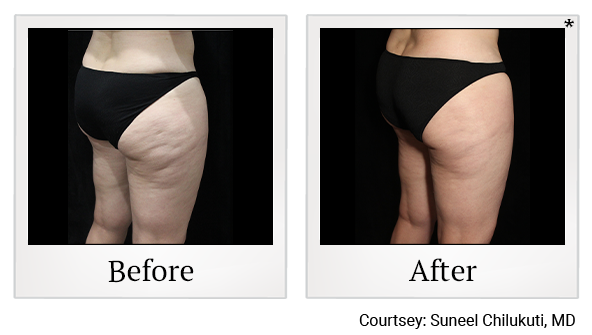 Results of Exilis Ultra treatment at Bay Area Med Spas in Oakland and Fremont