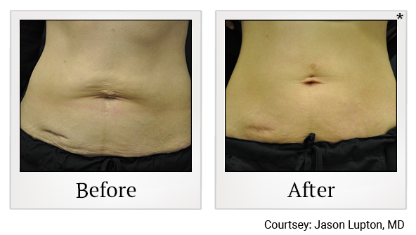 Results 20 of exilis ultra treatment at Bay Area Med Spas in Oakland and Fremont