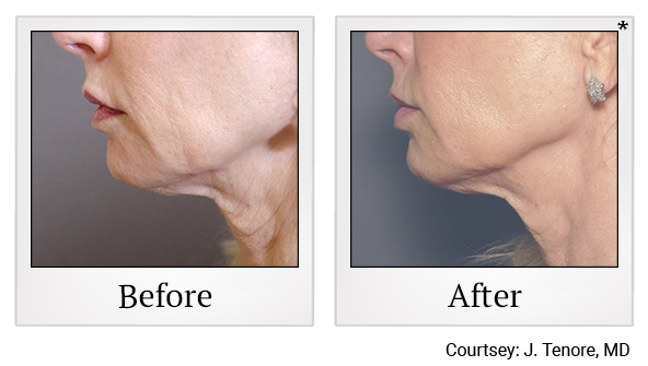 Results of Exilis Ultra treatment at Bay Area Med Spas in Oakland and Fremont