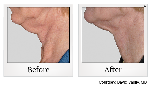 Results of Exilis Ultra treatment at Bay Area Med Spas in Oakland and Fremont